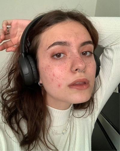 Skin Problems for Women