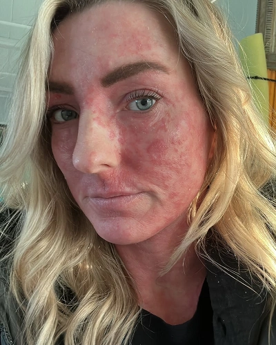 Adult Eczema