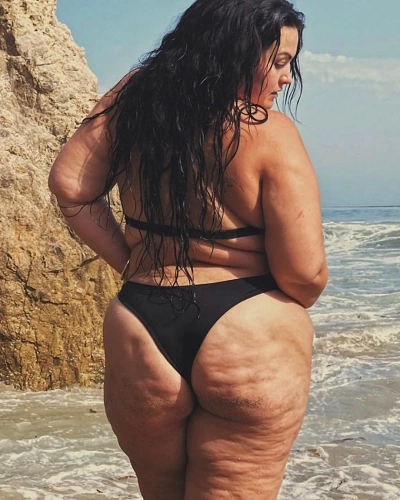 Cellulite
