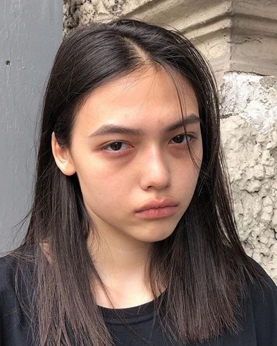 Dark Circles and Under Eye Bags