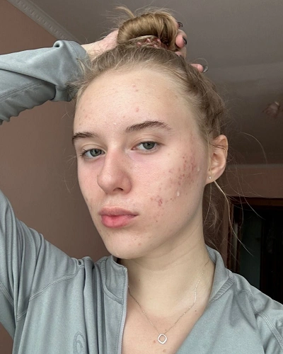 Hormonal Acne