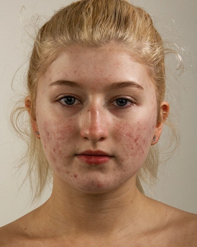 Hyperpigmentation