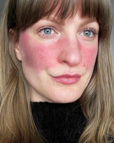Rosacea and Facial Redness
