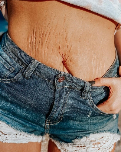Stretch Marks and Skin Sagging