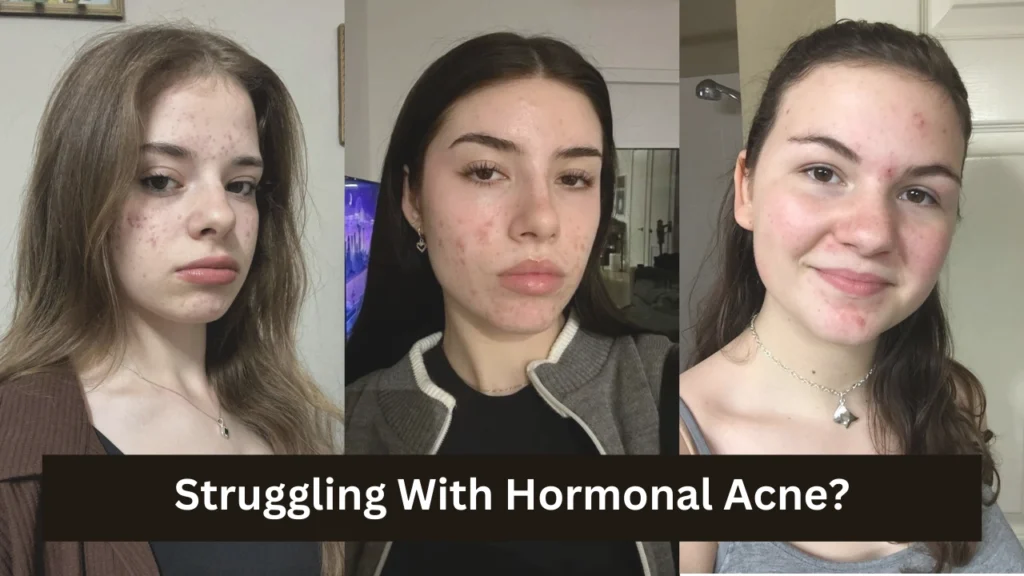 Struggling With Hormonal Acne?