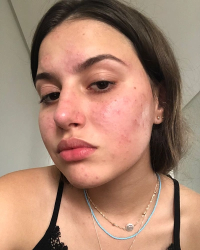 Uneven Texture and Rough Skin