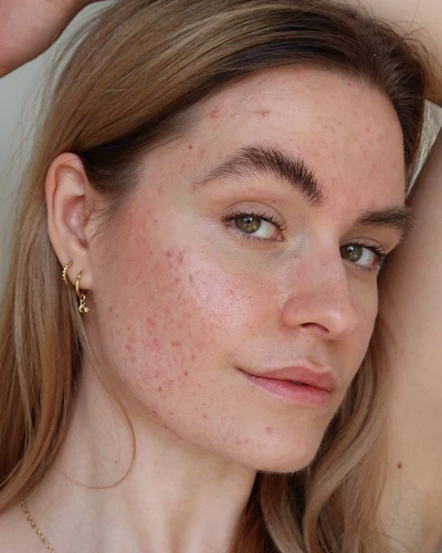 Uneven Texture and Rough Skin