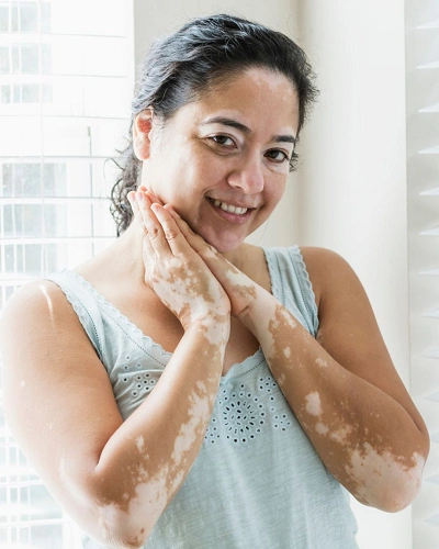 Acrofacial Vitiligo in Women