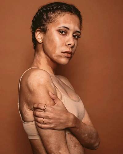 Universal Vitiligo