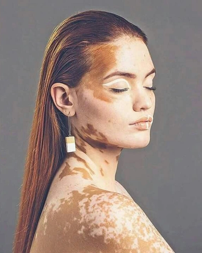 Vitiligo Around the Ears