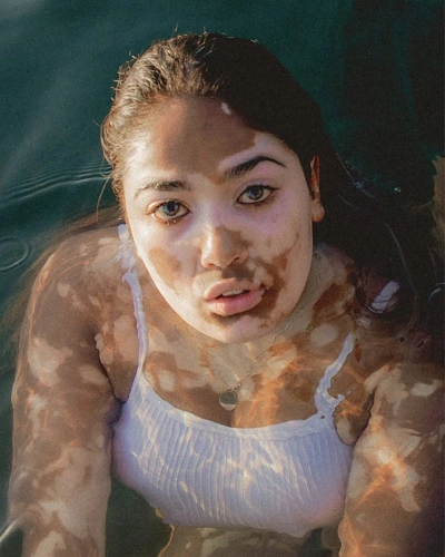 Vitiligo Around the eyes