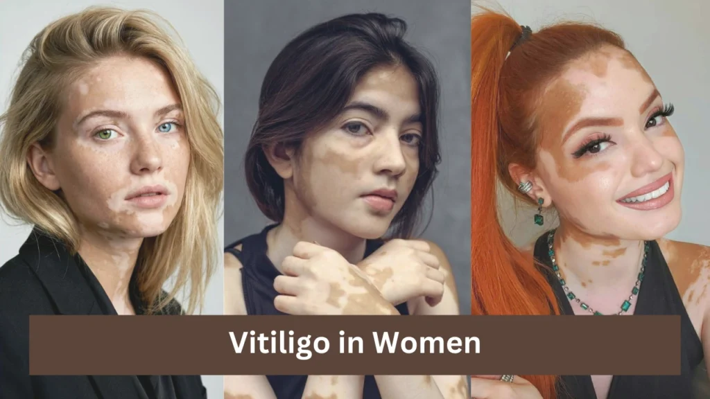 Vitiligo in Women