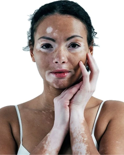 Vitiligo in Women