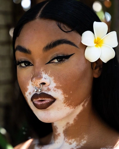 Vitiligo in the Beard Area