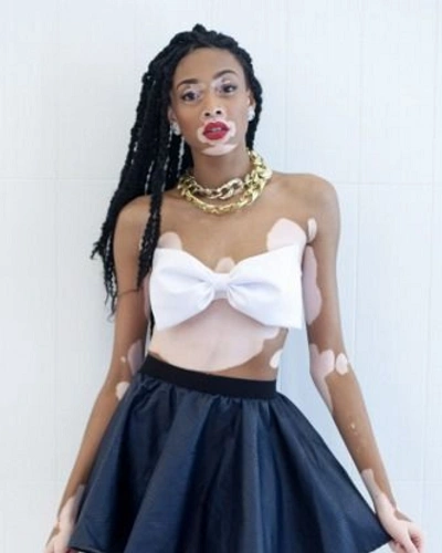 Vitiligo on the Abdomen