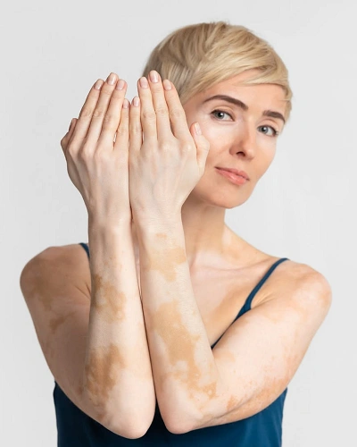 Vitiligo on the Arms