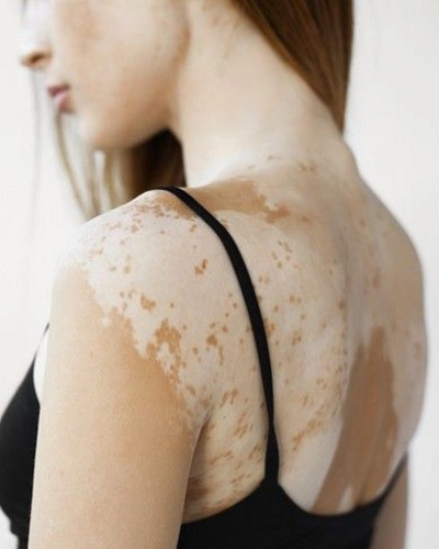 Vitiligo on the Back