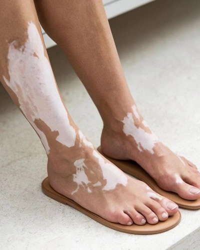 Vitiligo on the Feet
