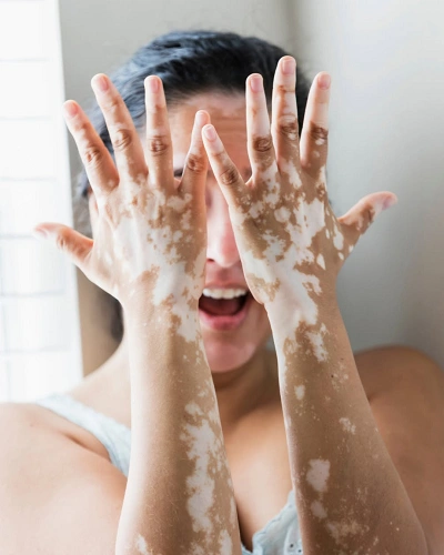 Vitiligo on the Fingers