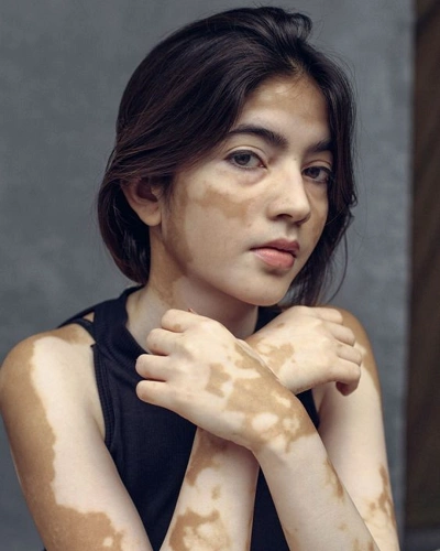 Vitiligo on the Hands