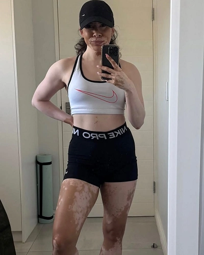 Vitiligo on the Inner Thighs