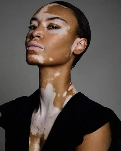 Vitiligo on the Neck